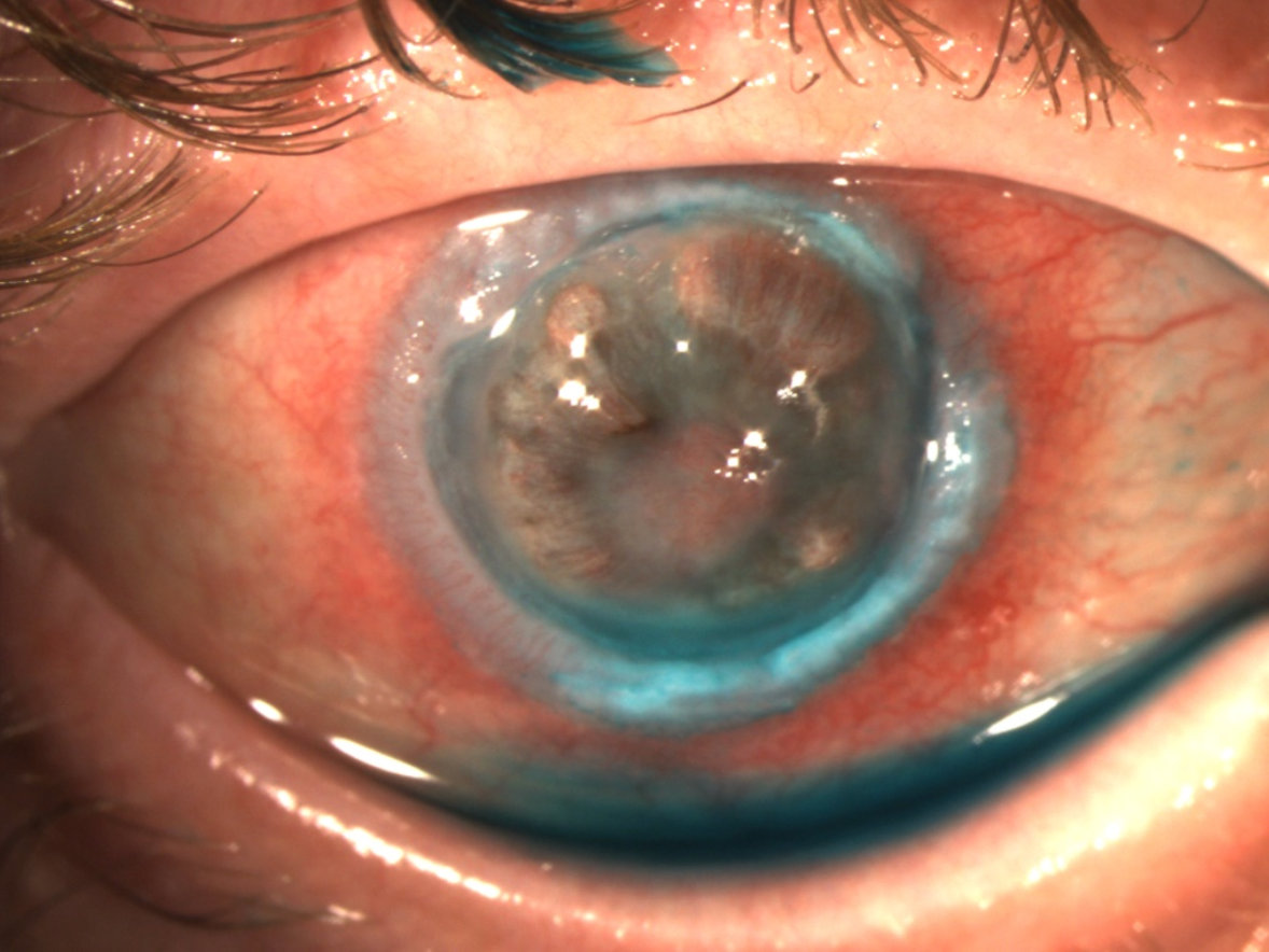 External photograph of the right eye demonstrating marked conjunctival inflammation with diffuse injection, corneal ectasia characterized by 360-degree limbal thinning, a superotemporal descemetocele, and diffuse stromal haze.