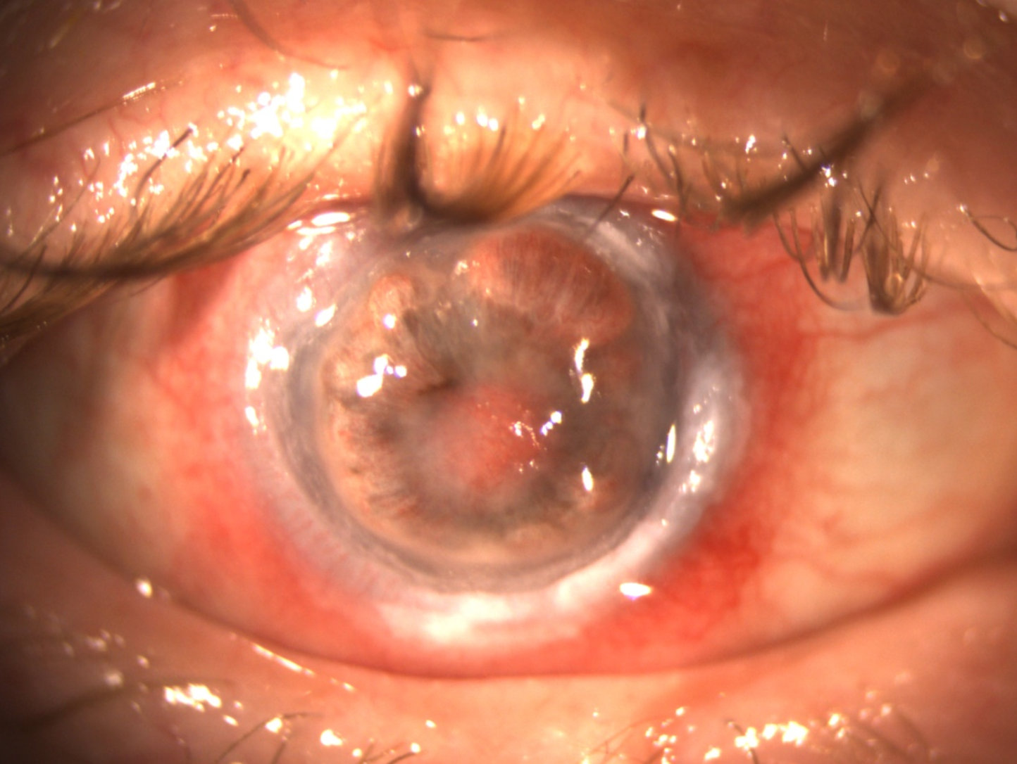 External photograph of the right eye showing peripheral superior and inferior corneal pannus with superonasal corneal neovascularization.