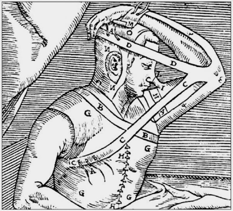 (Left) An illustration depicting the arm flap technique for nasal reconstruction, which was initially developed by the Branca family in the 15th century and later refined and popularized by Gaspare Tagliacozzi in the 16th century.