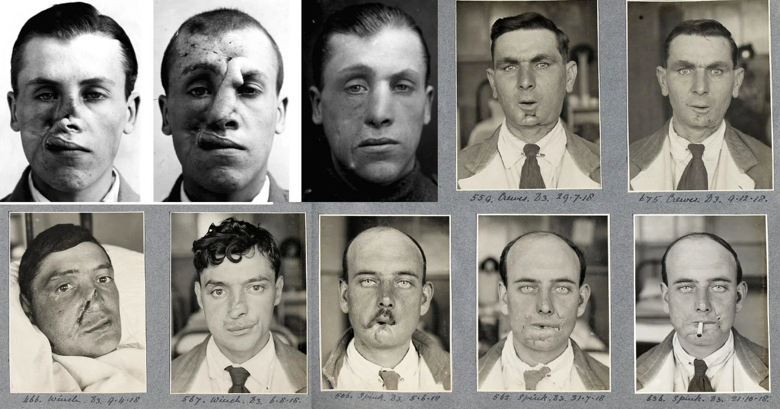 Before (A) and after (B) images of one of the first documented rhinoplasty patients, performed by Dr. John Orlando Roe in the late 19th century. Roe is credited with pioneering aesthetic rhinoplasty, focusing on the psychological well-being of patients suffering from nasal deformities.