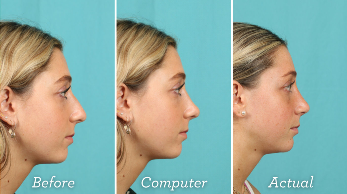 Closed rhinoplasty technique. The diagrams illustrate the difference between open and closed rhinoplasty procedures. Closed rhinoplasty, shown on the right, involves incisions made inside the nostrils, leaving no visible external scars.