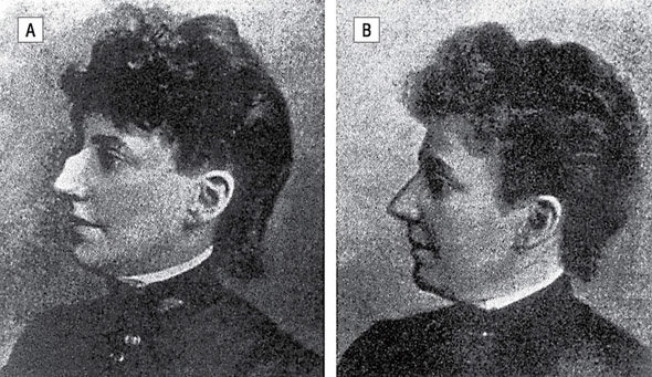 A historical advertisement promoting a non-surgical nasal correction device called the “Trados Nose-Shaper” from the early 20th century. The device claims to reshape “ill-shaped” noses without surgery by applying external pressure.