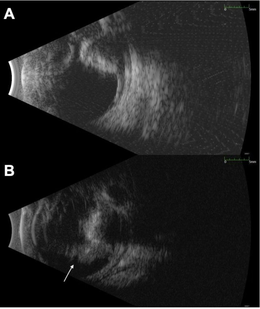 Ultrasonography B-Scan mode from OS. Image A: Calcified, stable tumor post-treatment. Image B: Image taken 3.5 years after Image A, at the time of vitreous hemorrhage.