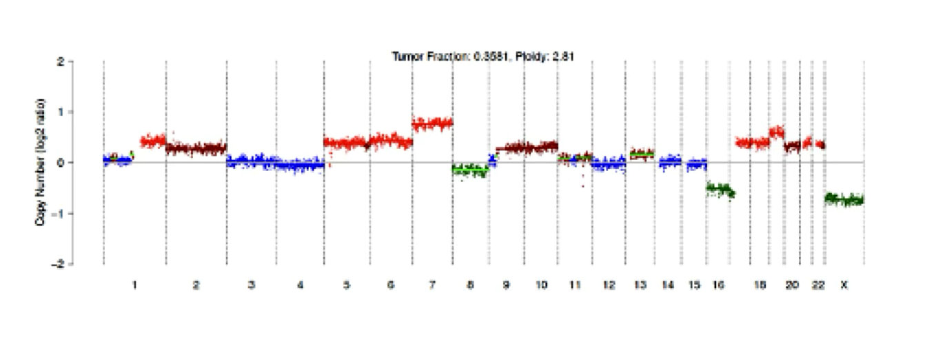 Somatic copy number alteration profile from cell-free DNA derived from aqueous humor. Profile shows gains (in red) of 1q, 2, 5, 6, 7, 9q, 10, 13, 18-22, and losses (in green) of 8 and 16.