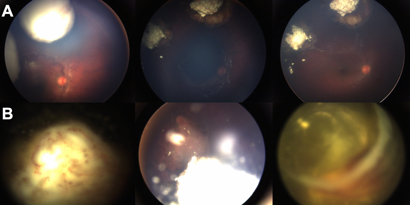 Fundus photos taken at different time points: diagnosis (left), during stability period following globe-sparing treatment (center), and at 3.5 years follow-up (