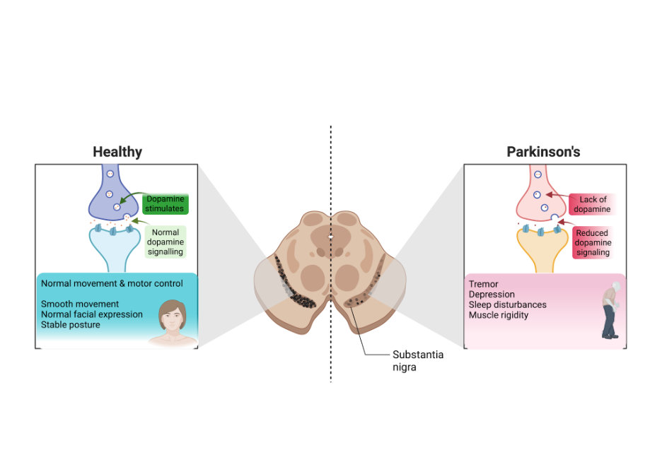 Comparison between healthy and degenerated dopaminergic signaling in Parkinson’s disease. Figure generated with BioRender.