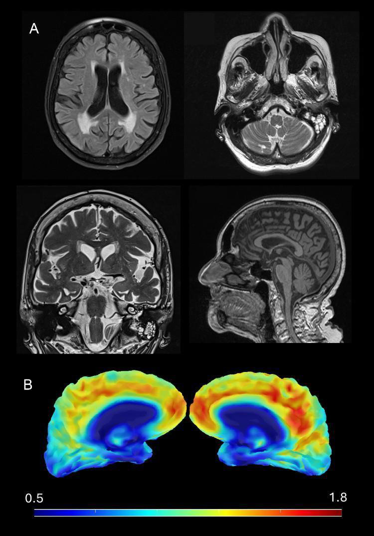 Index case neuroimages MRI and PET-FDG at the age of 102. 2A) Brain MRI at 102 years with generalized involutional changes and the findings described in the tex