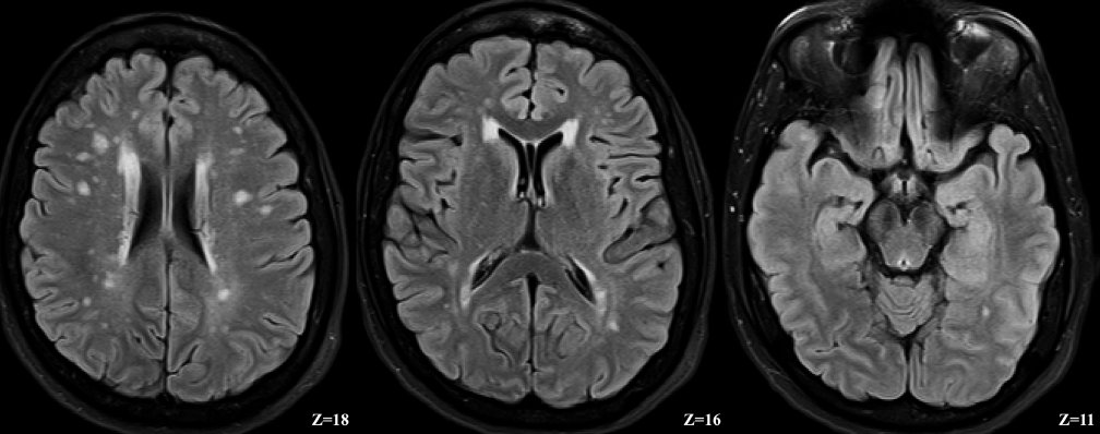 White Matter Hyperintensity on Fluid-Attenuated Inversion Recovery. Presence of white matter hyperintensity in the CADASIL case, visualized on a fluid-attenuated inversion recovery (FLAIR) in the semioval centers, corona radiata, and some small ones in the temporal poles.